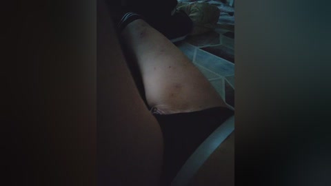 Video of a person's bruised and scraped thigh, partially covered by black underwear, in a dimly lit room with a bed and scattered objects.