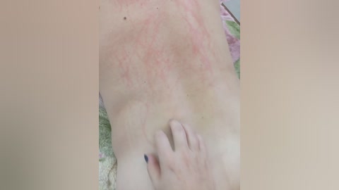 Media: Video of a light-skinned person lying on their back, showing a red, inflamed rash on the chest. A hand with blue nails gently touches the rash. The background is a green towel.