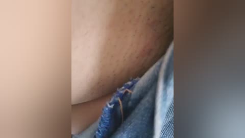 Close-up video of a light-skinned person's arm with visible redness and slight swelling, wearing a blue denim shirt, suggesting a medical condition like dermatitis.